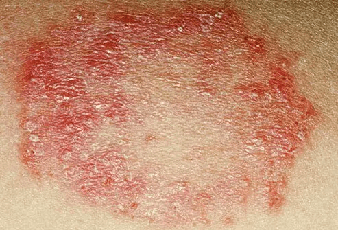 Close-up medical photograph showing a typical ringworm fungal skin infection — a scaly, ring-shaped rash with a raised border